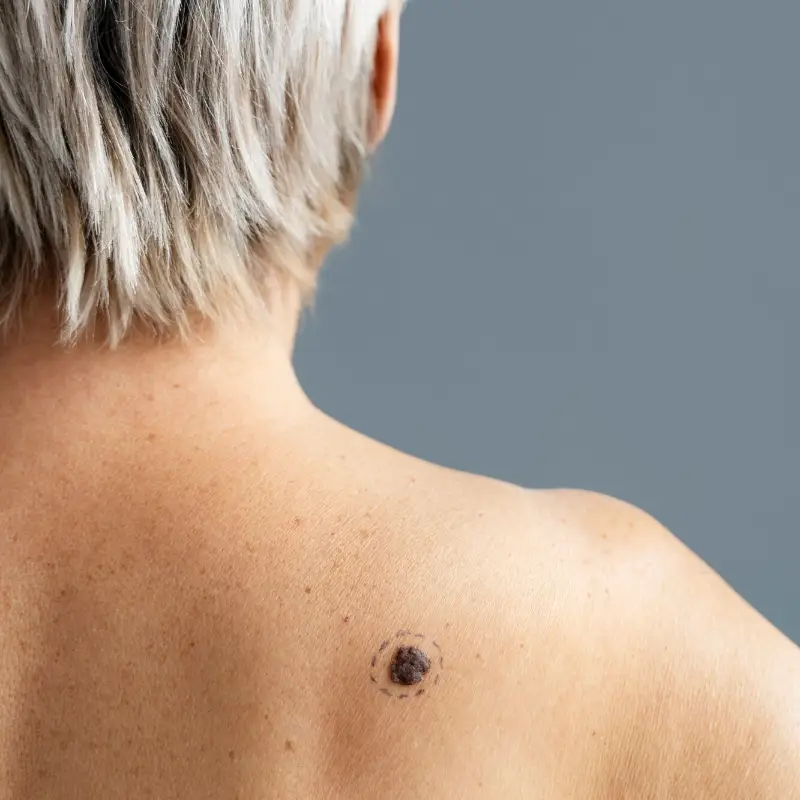Back view woman with melanoma