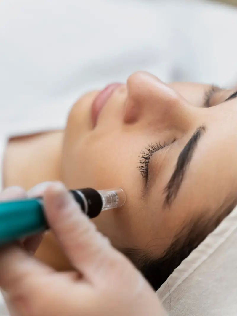 Person getting micro needling beauty treatment